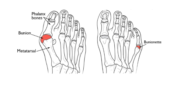 A bunion and bunionette or tailor’s bunion